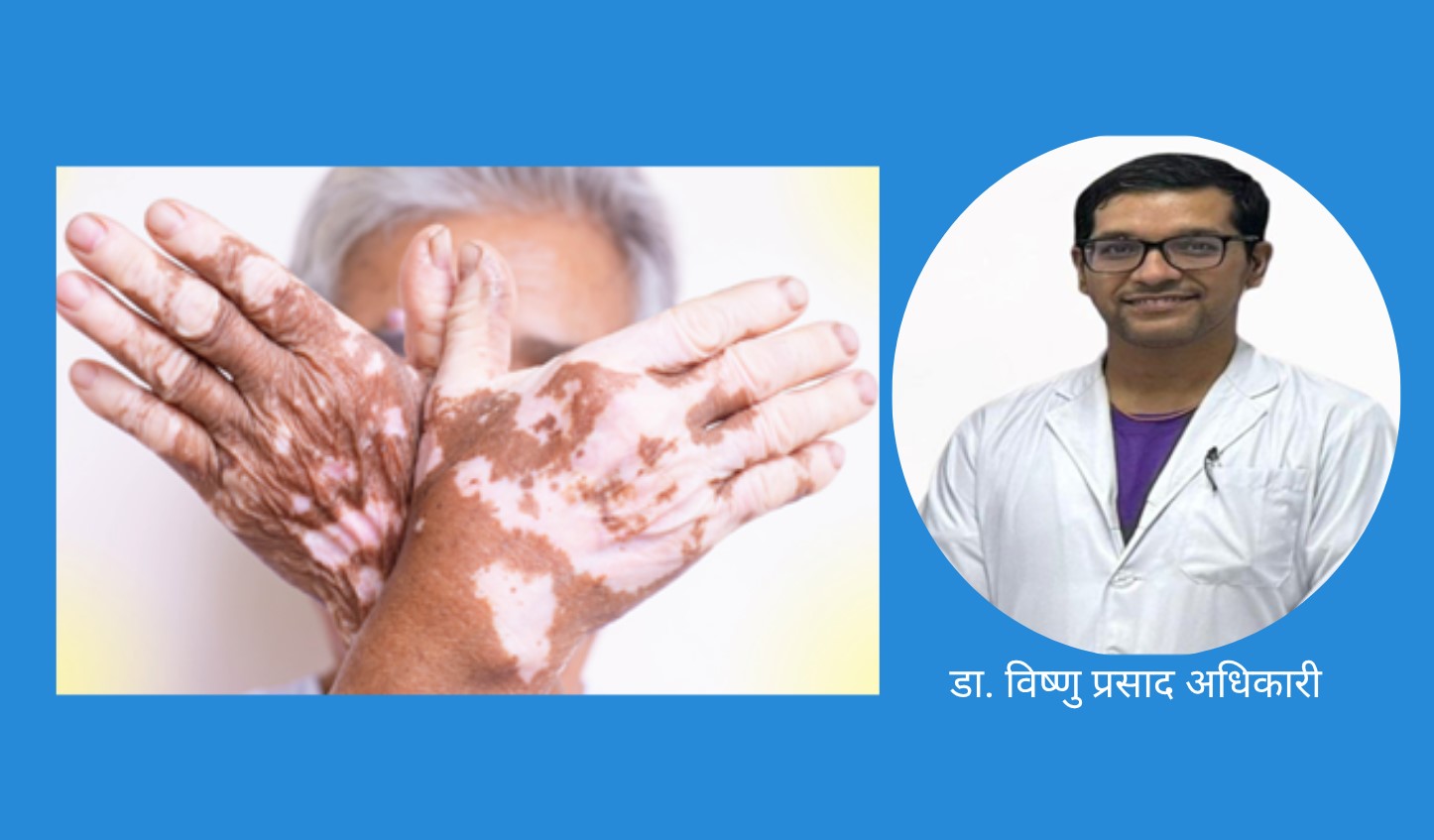 विश्व सेतो दुबी दिवसस् रोग छालाको, प्रश्न चेतनाको