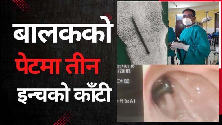 बालकले निले तीन इञ्चको काँटी,  जनकपुर अस्पतालमा डा चौधरीको टिमले अप्रेसन नगरी निकाल्न सफल